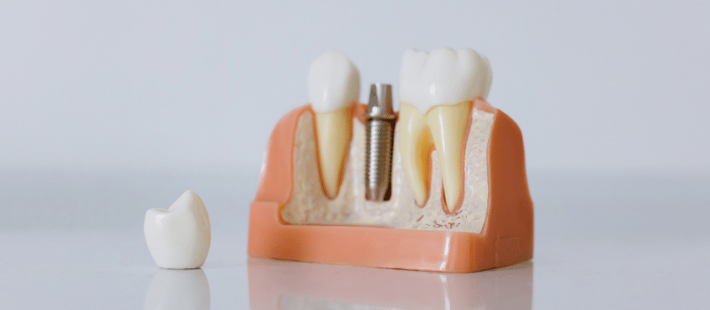 Subashi Dental Clinics - Dental Implants